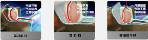 关注睡眠健康,警惕睡眠呼吸障碍